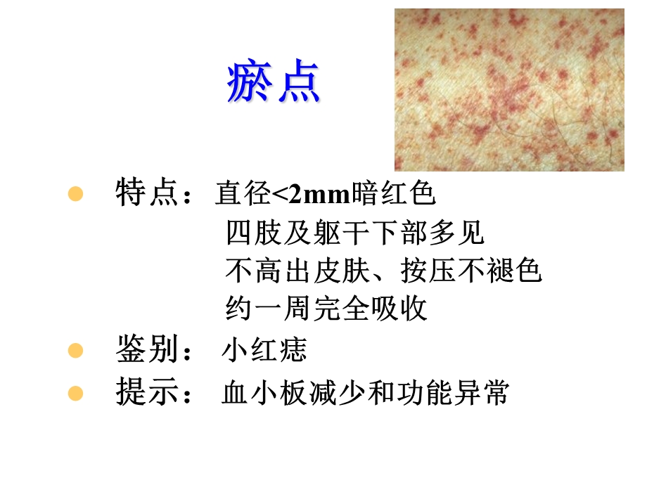 出血点(瘀点)紫癜瘀斑皮下血肿血疱鼻出血(鼻衄)课件.ppt_第2页