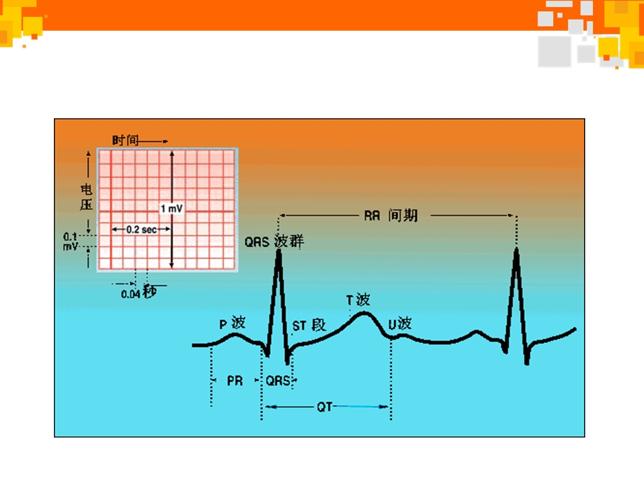 巧学常见心律失常心电图【心血管内科】.ppt_第3页