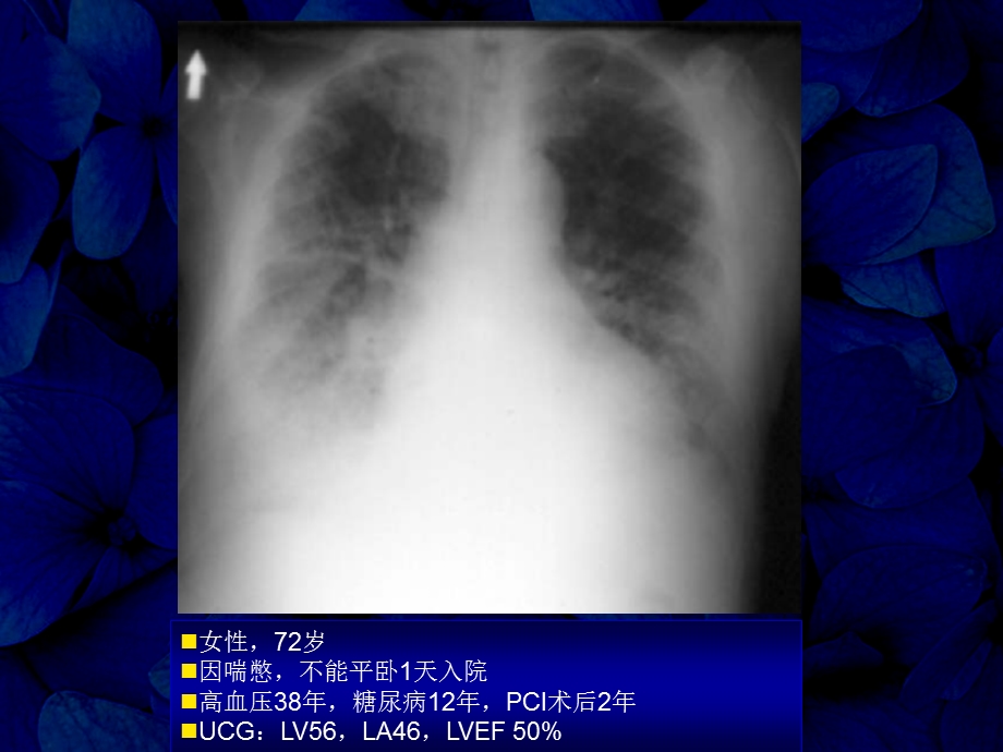 正常射血分数正常心力衰竭的诊断和治疗进展课件.ppt_第2页