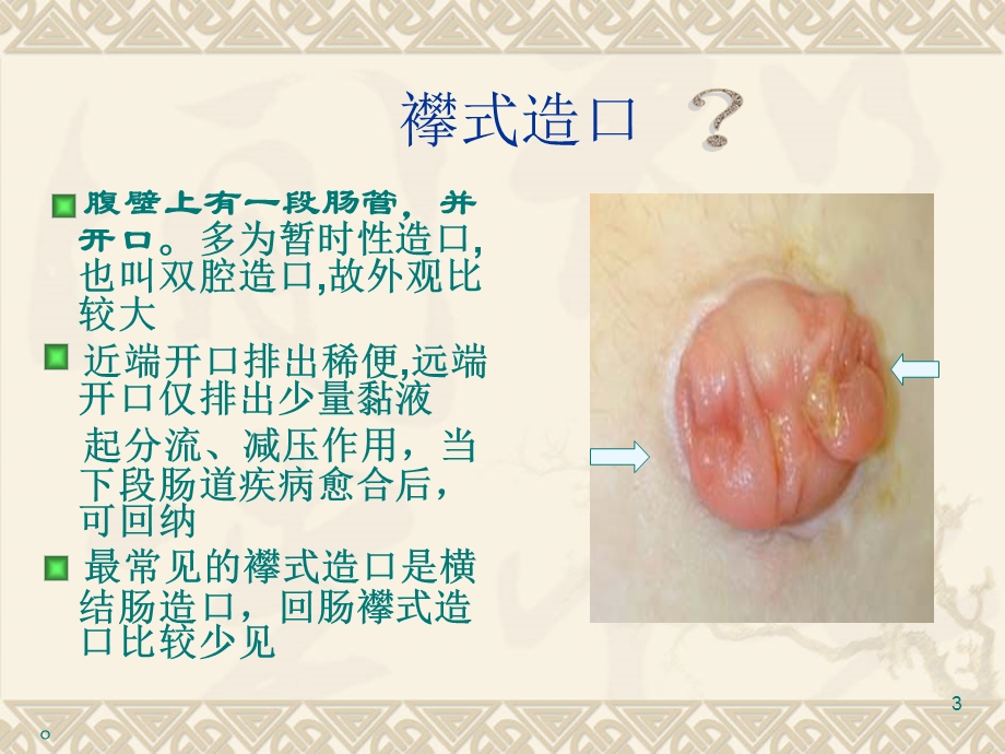 造口病人的清洁灌肠方法课件.ppt_第3页