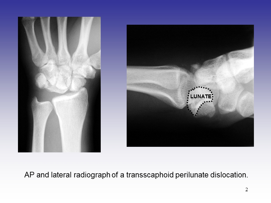 月骨脱位手术图解课件.ppt_第2页
