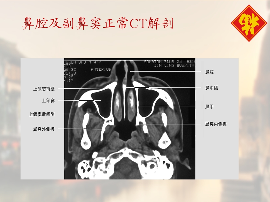 鼻与鼻窦病变CT诊断课件.ppt_第2页