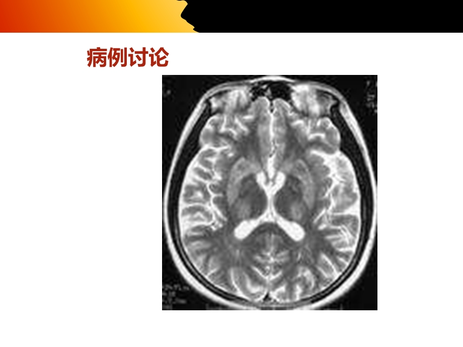 肝豆状核变性病例讨论课件.ppt_第2页