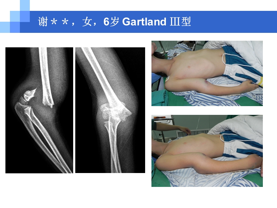 伸直型儿童肱骨髁上骨折课件.ppt_第2页