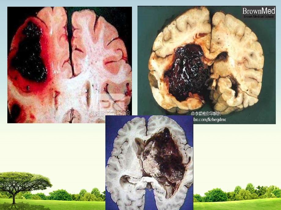 脑出血内科课件.ppt_第2页