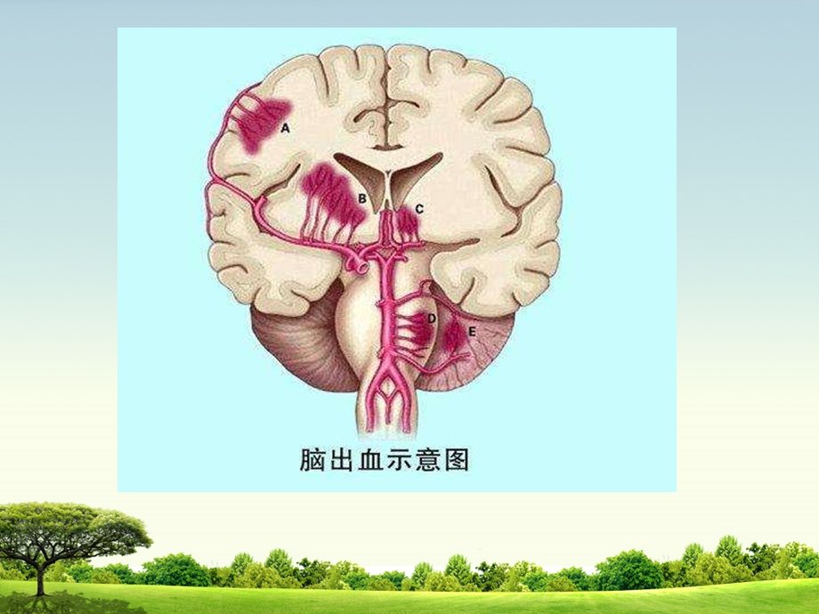 脑出血内科课件.ppt_第3页