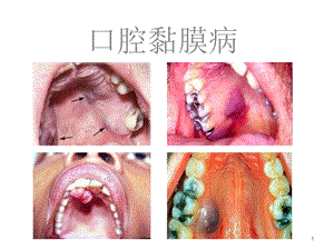 口腔黏膜病课件.ppt