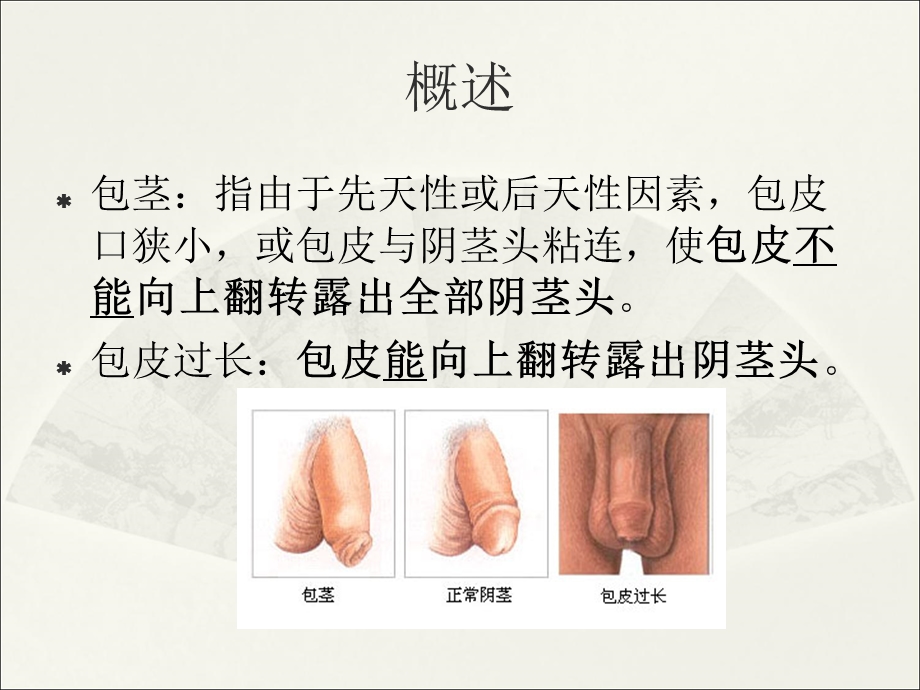 包茎包皮过长课件.ppt_第2页