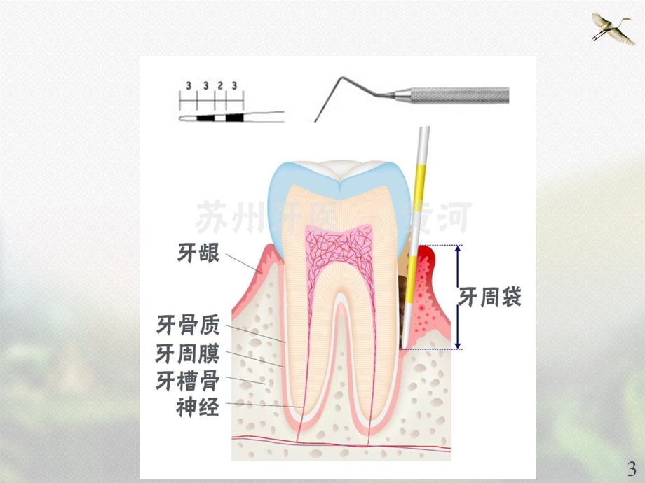 口腔内科学 牙周组织病课件.ppt_第3页