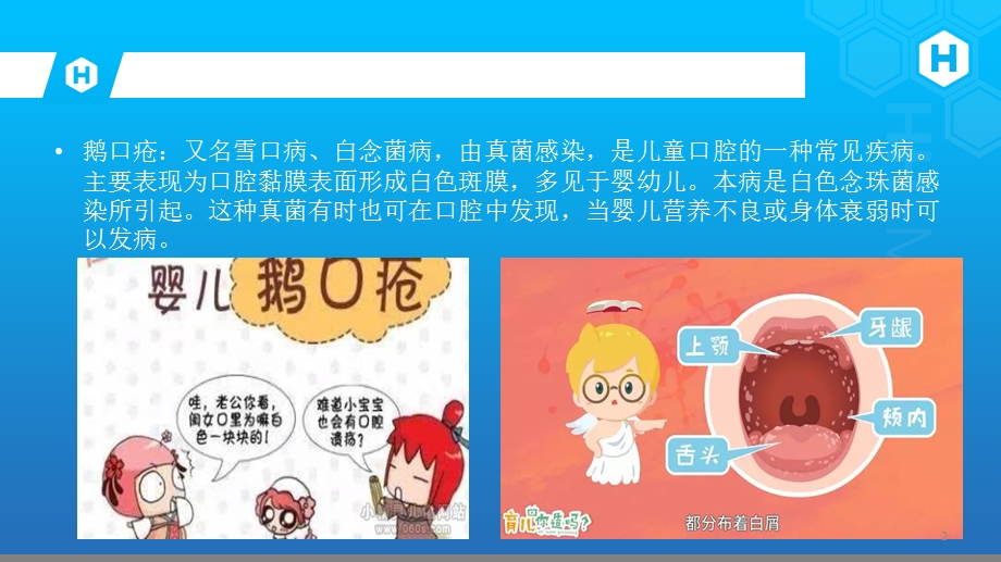 婴幼儿鹅口疮课件.ppt_第2页