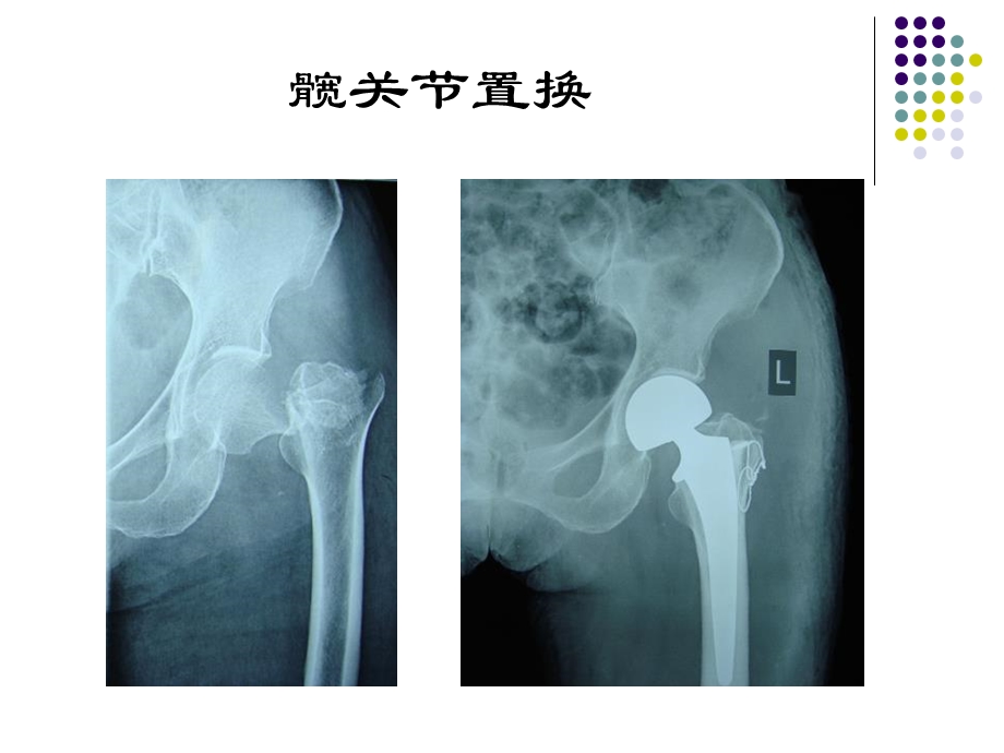 髋膝关节置换术后功能锻炼指导课件.pptx_第3页