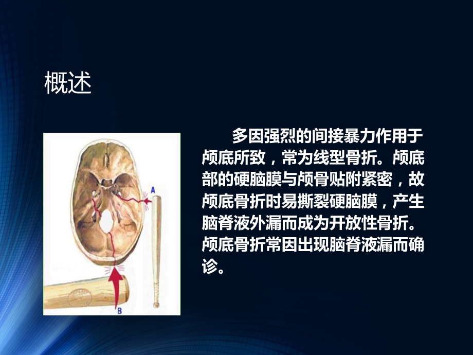 颅底骨折护理课件.ppt_第2页