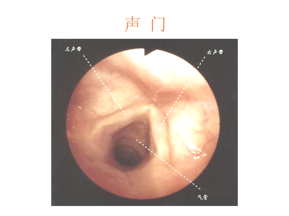 纤支镜的临床图谱课件.ppt_第3页