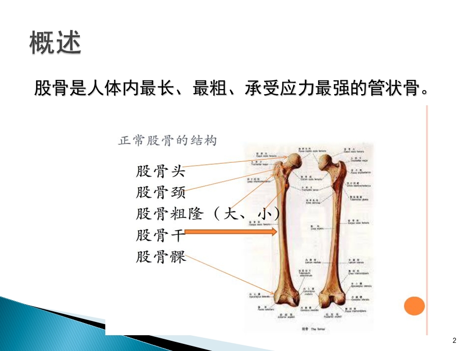 股骨骨折的健康宣教课件.ppt_第2页