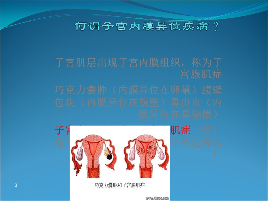 子宫内膜异位症护理课件.ppt_第3页