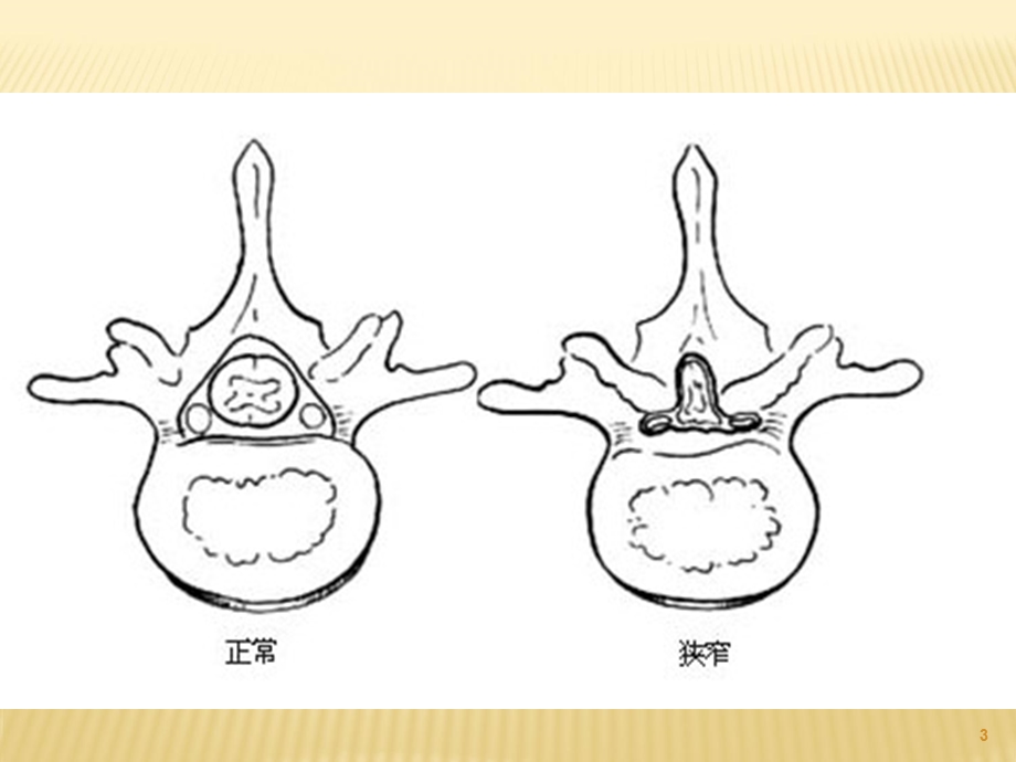 腰椎管狭窄课件.ppt_第3页