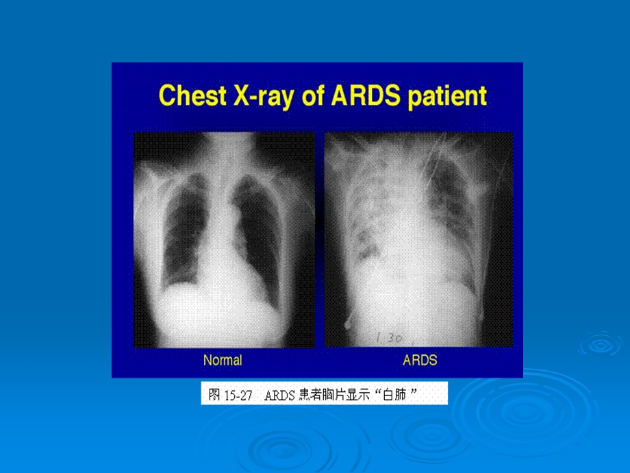 急性呼吸窘迫综合征ARDS护理查房课件.ppt_第2页