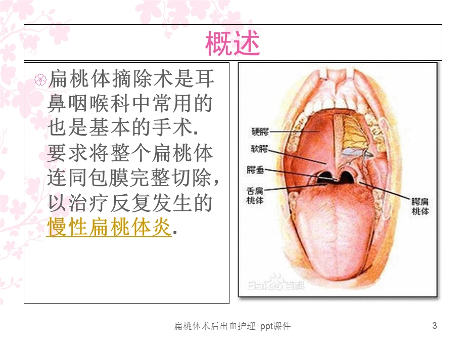 扁桃体术后出血护理 课件.ppt_第3页