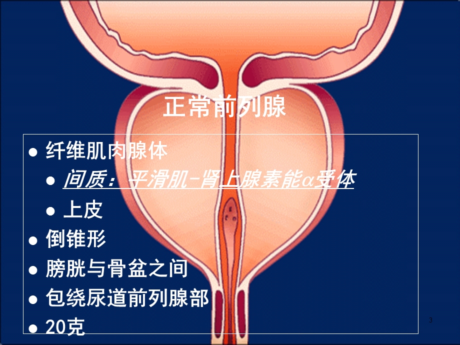 梗阻良性前列腺增生(BPH)课件.ppt_第3页