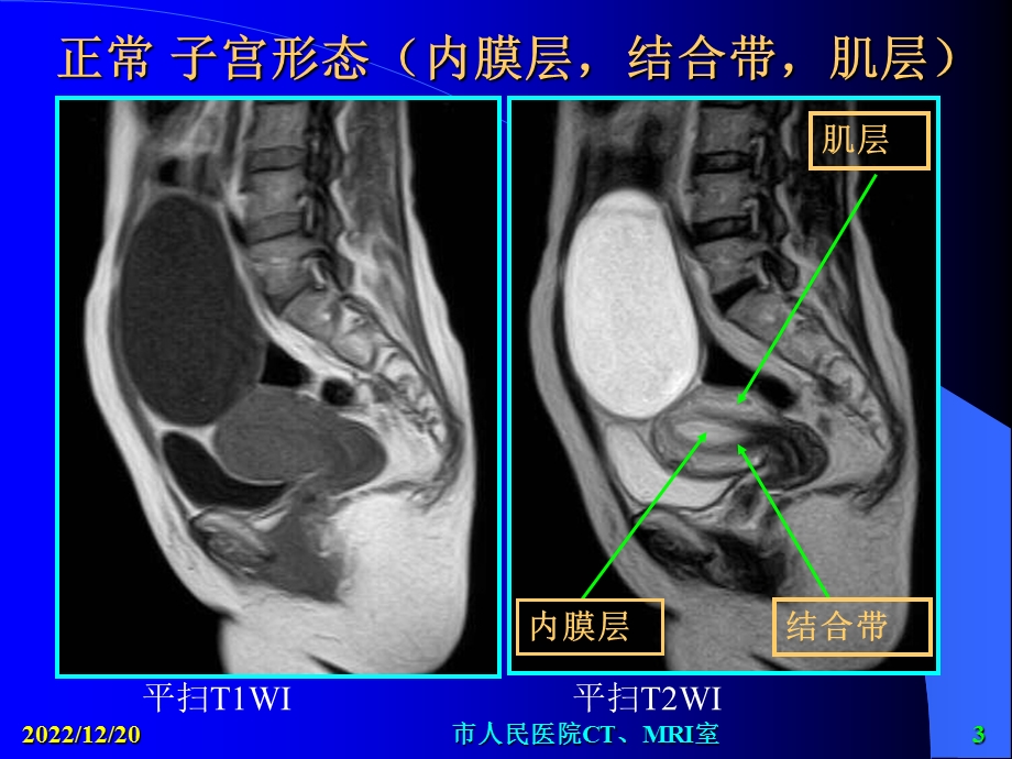 剖宫产子宫疤痕妊娠MRI课件.ppt_第3页