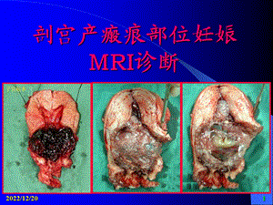 剖宫产子宫疤痕妊娠MRI课件.ppt