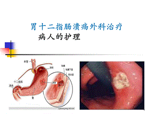 胃十二指肠溃疡外科治疗病人的护理课件.ppt