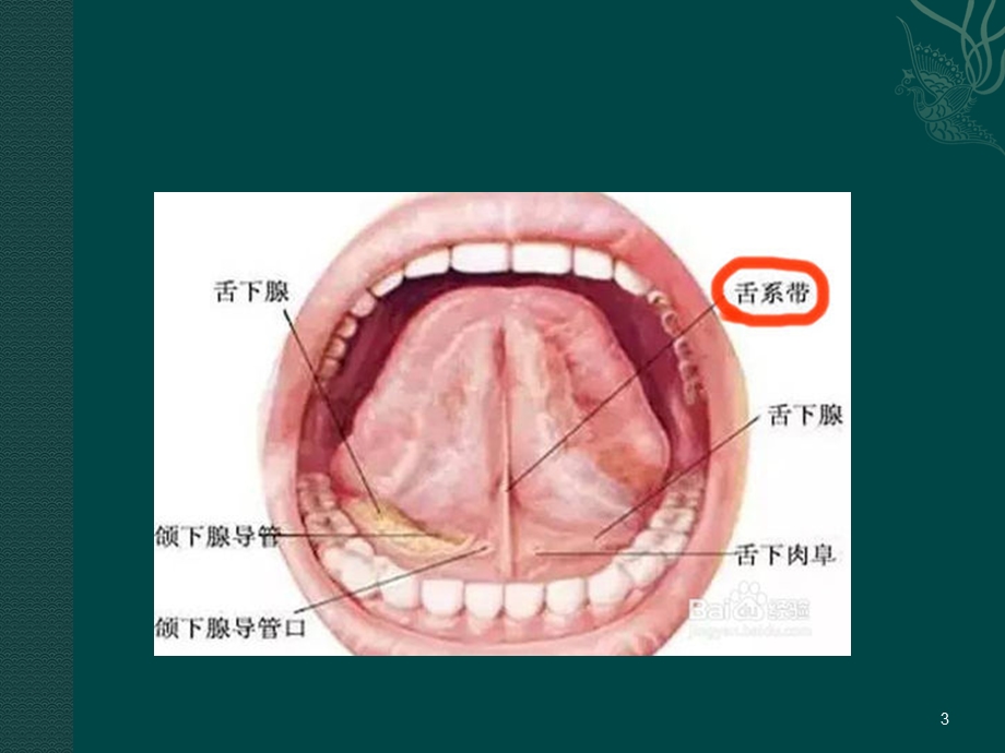 舌系带过短的诊断与治疗课件.ppt_第3页