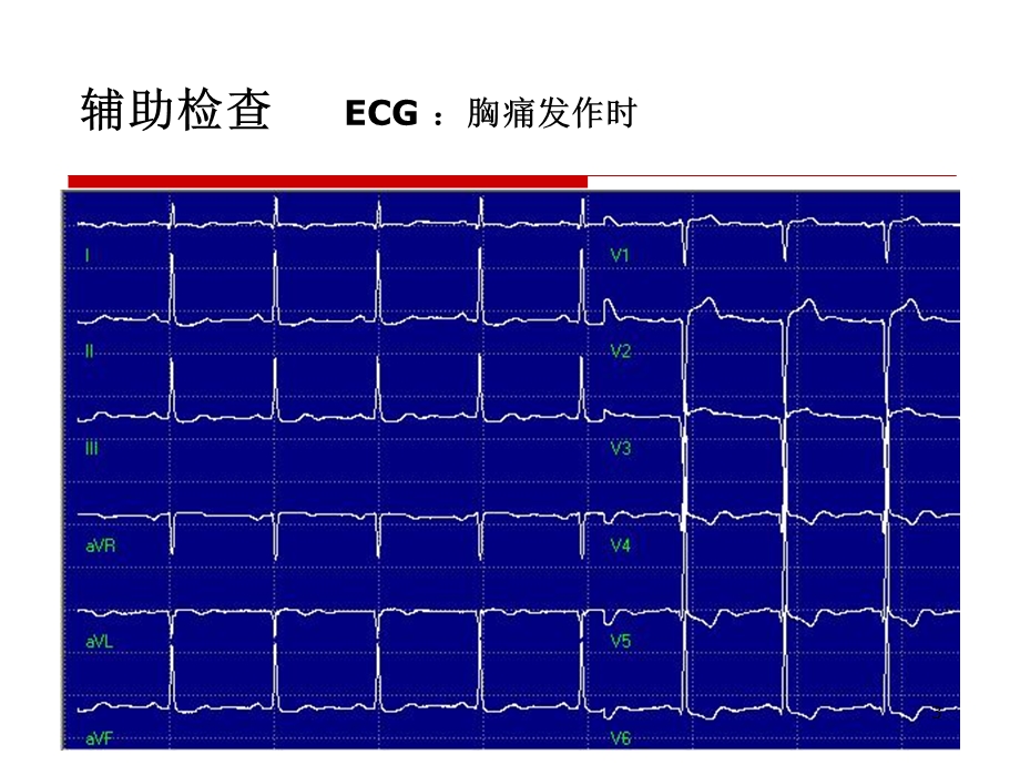 急、慢性心包积液的处理策略课件.ppt_第3页