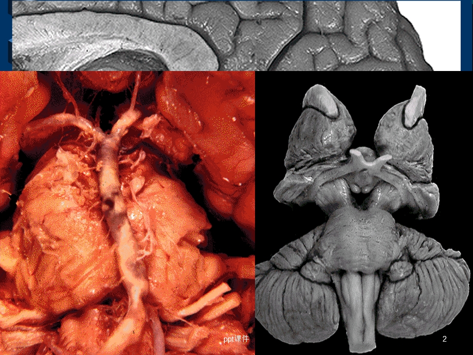 脑干解剖及脑干综合征课件.ppt_第2页