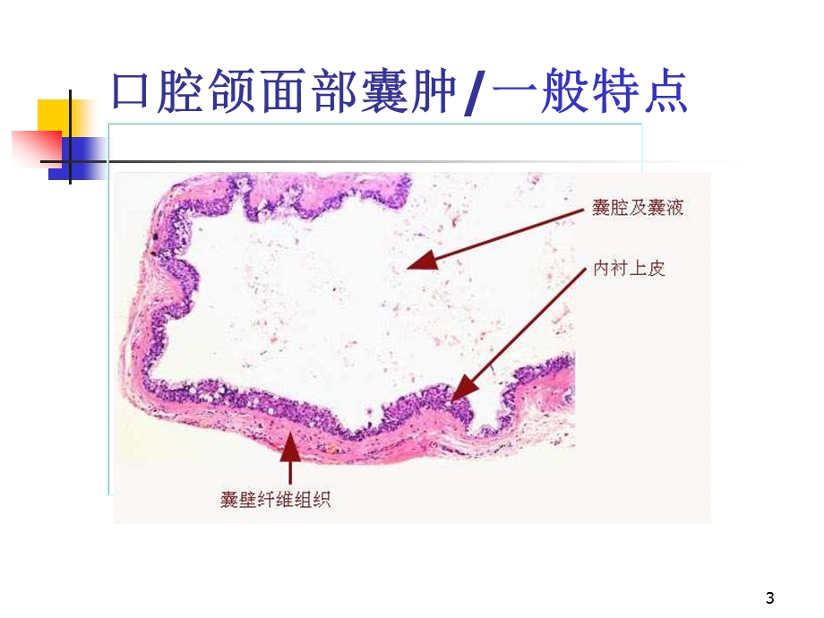 口腔颌面囊肿课件.ppt_第3页