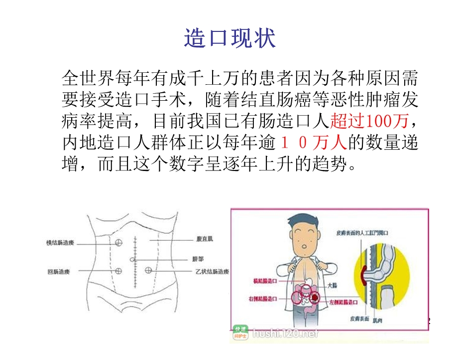 造口护理健康宣教 课件.ppt_第2页