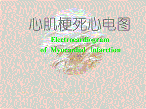 心肌梗死心电图【心脏内科】课件.ppt