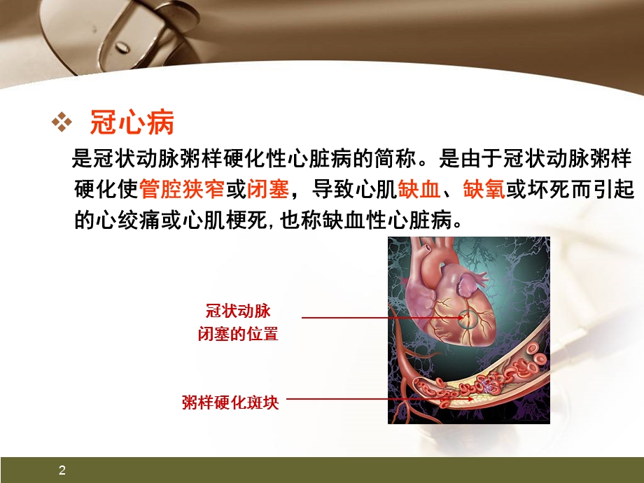 心肌梗死健康宣教幻灯片精品课件.pptx_第2页