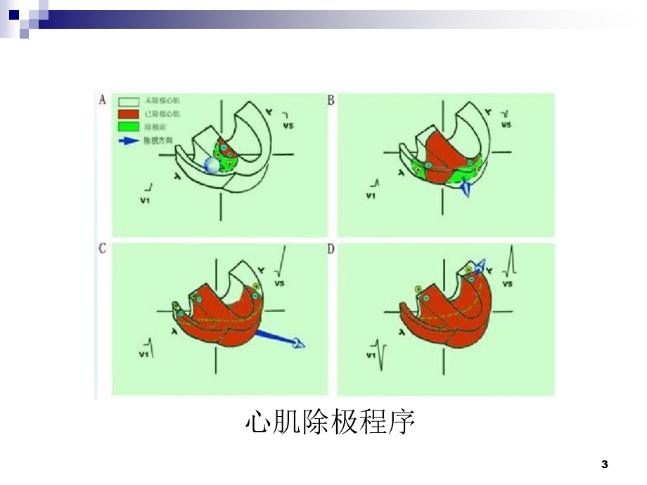 初学室性心动过速课件.ppt_第3页