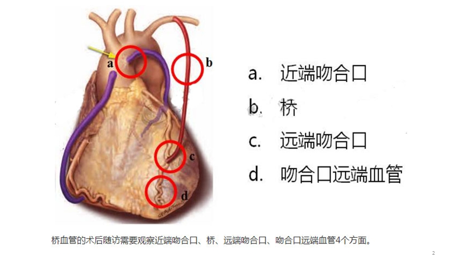 桥血管造影课件.ppt_第2页