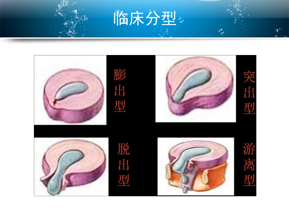 微创通道下显微椎间盘髓核摘除术治疗腰椎间盘突出神课件.ppt_第3页