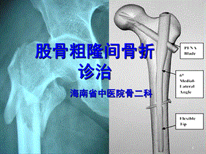 股骨粗隆间骨折诊治课件.ppt