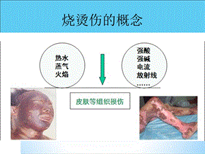 烧烫伤急救处理 课件.ppt