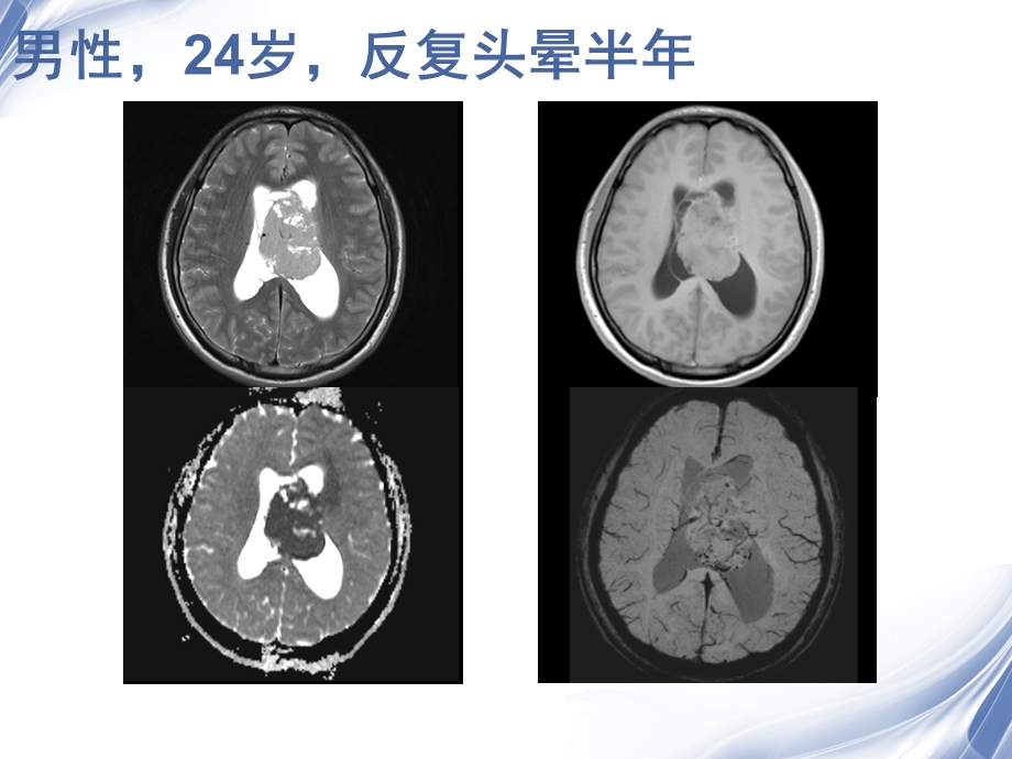 侧脑室肿瘤的鉴别诊断课件.ppt_第2页