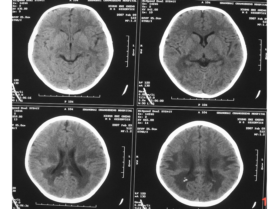 常见脑白质病课件.ppt_第3页