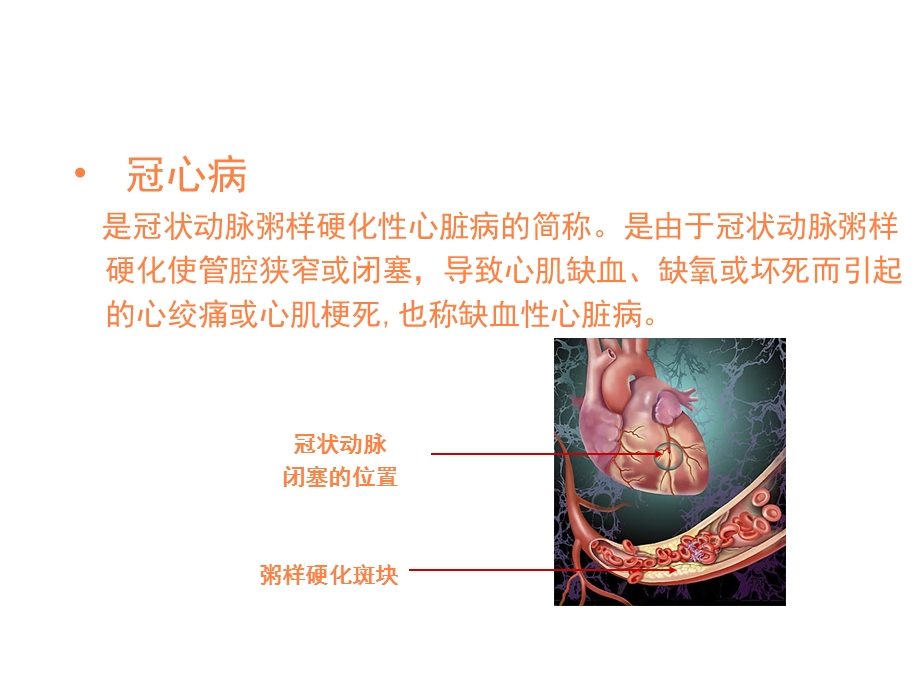 心肌梗死健康宣教课件.ppt_第2页