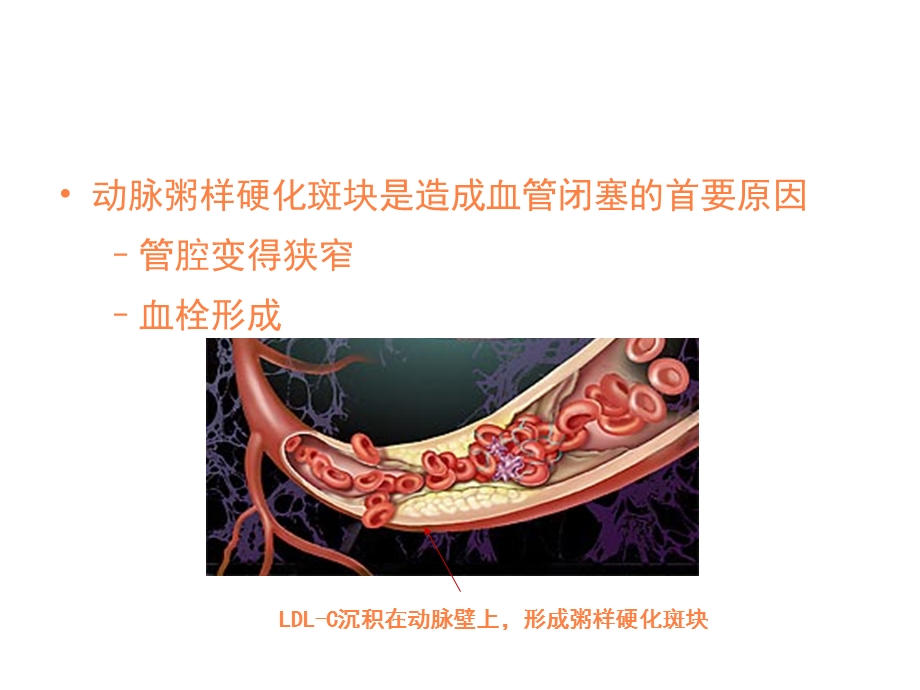 心肌梗死健康宣教课件.ppt_第3页