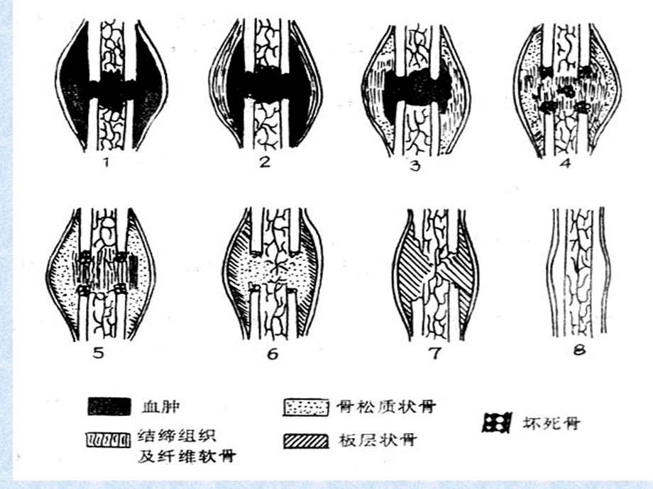 骨科手术后功能锻炼课件.ppt_第3页