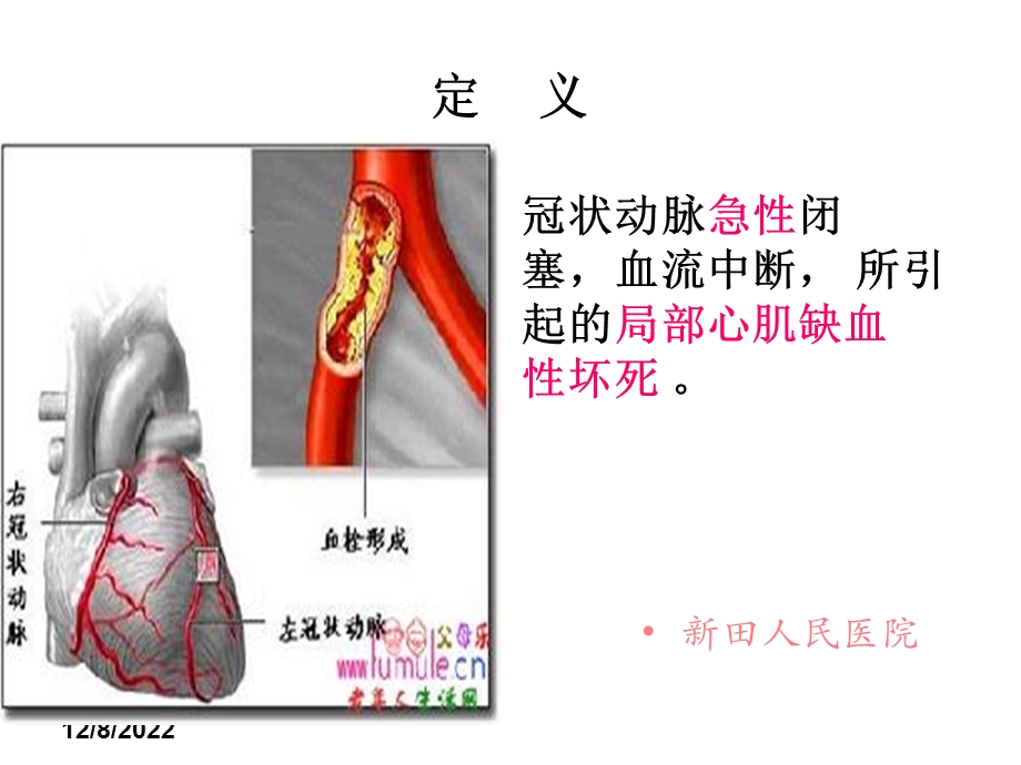 急性心肌梗塞护理查房课件.ppt_第3页