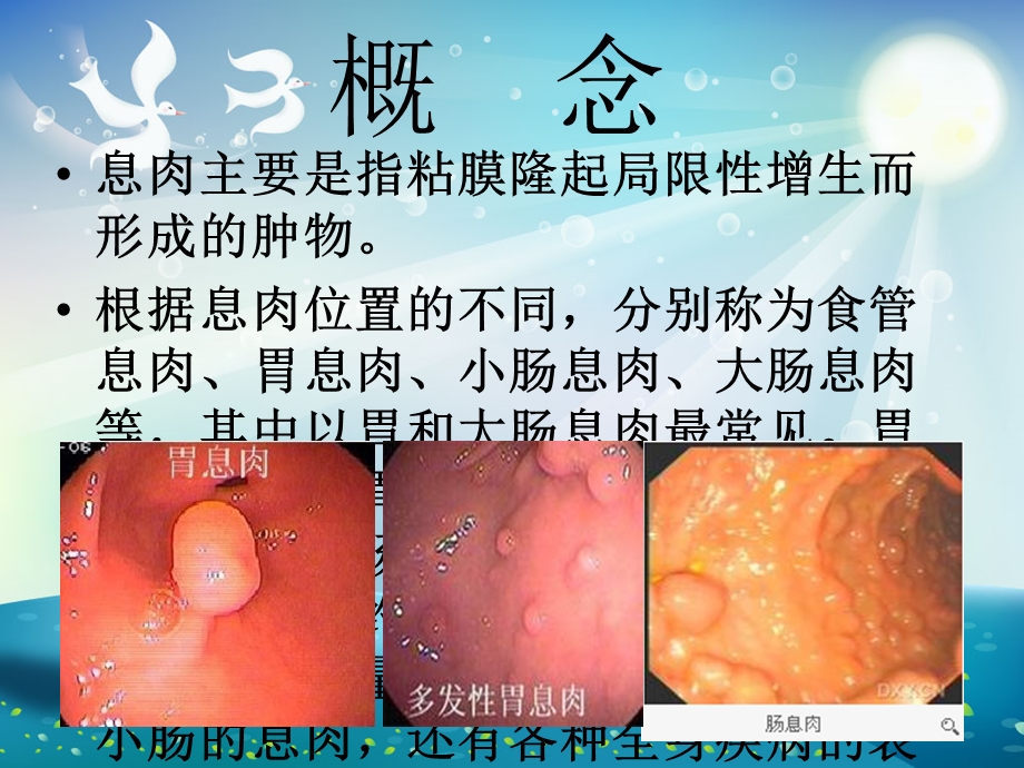 胃肠息肉摘除术ppt课件.ppt_第1页