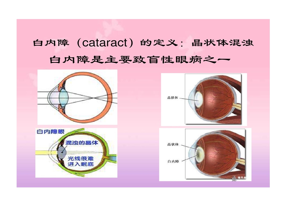 白内障和青光眼病人护理课件.ppt_第2页