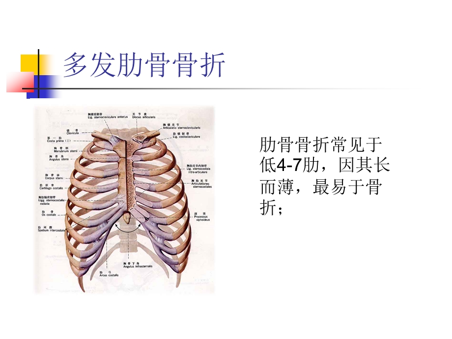 肋骨骨折合并血气胸的护理课件.ppt_第1页