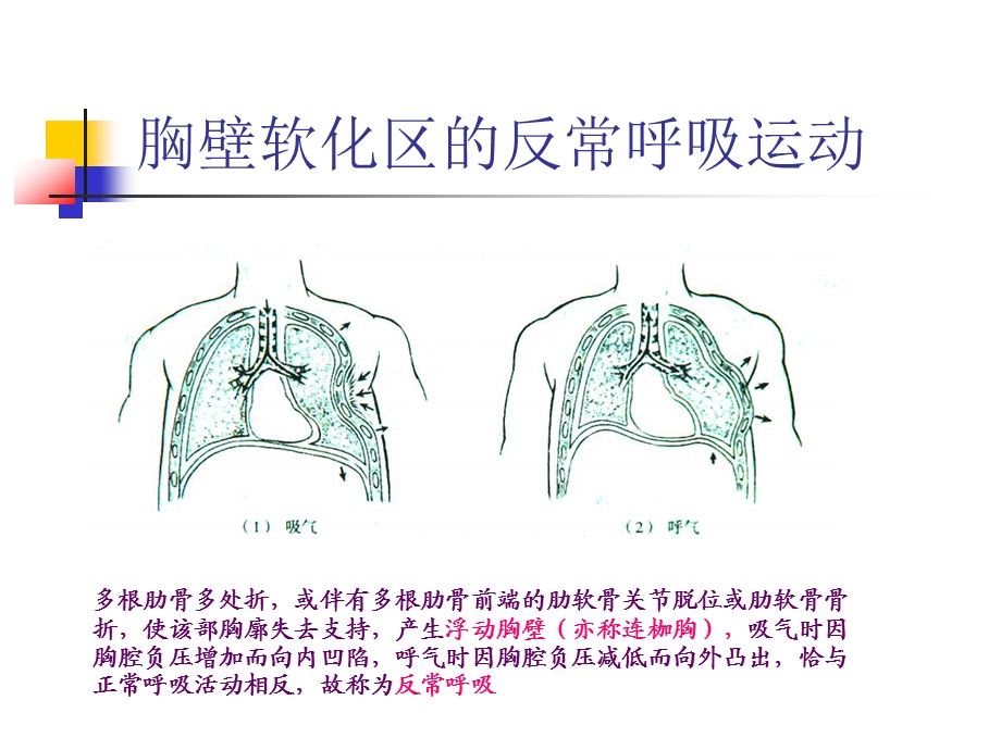 肋骨骨折合并血气胸的护理课件.ppt_第3页