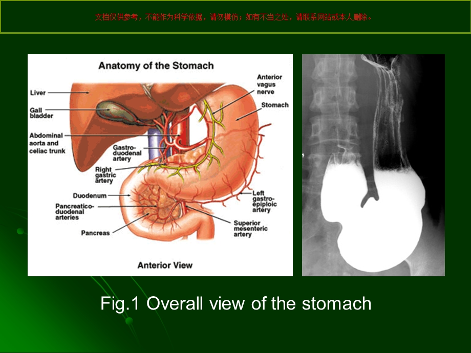 腹腔镜远端胃癌手术解剖ppt课件.ppt_第2页