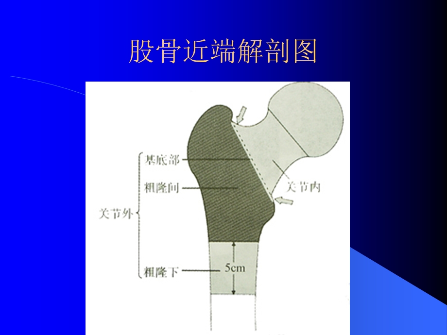 股骨粗隆间骨折课件.ppt_第3页